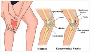 kondromalazi patella