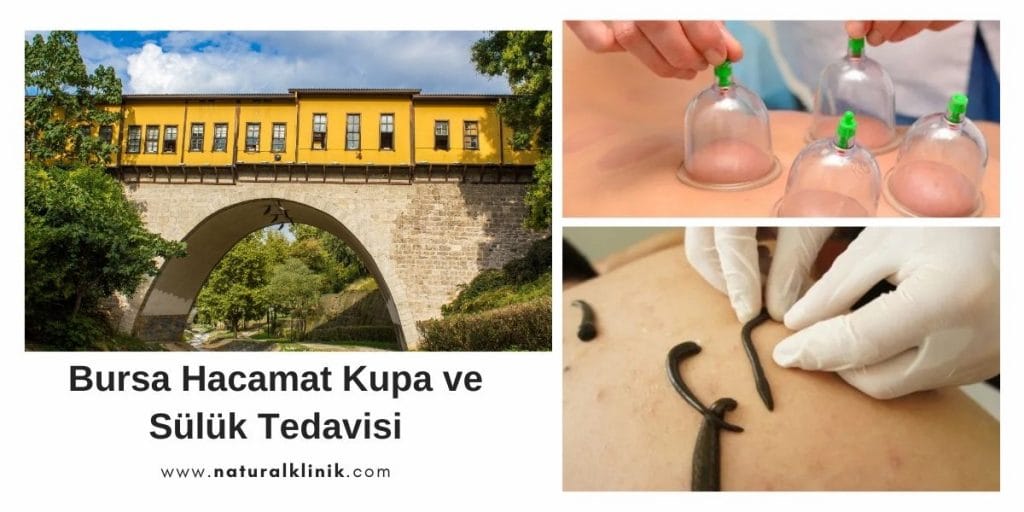 Bursa Nilüfer Hacamat Kupa ve Sülük Tedavisi