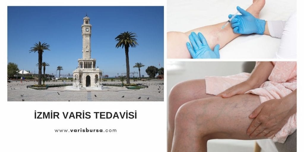 İzmir Varis Tedavi