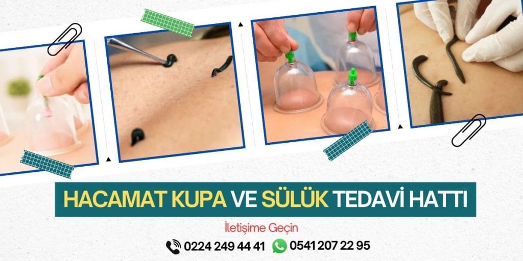 Bursa Nilüfer Hacamat Kupa ve Sülük Tedavisi