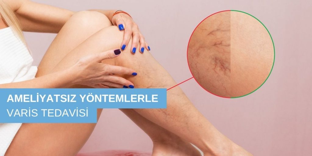 Ameliyatsız Yöntemlerle Varis Tedavisi